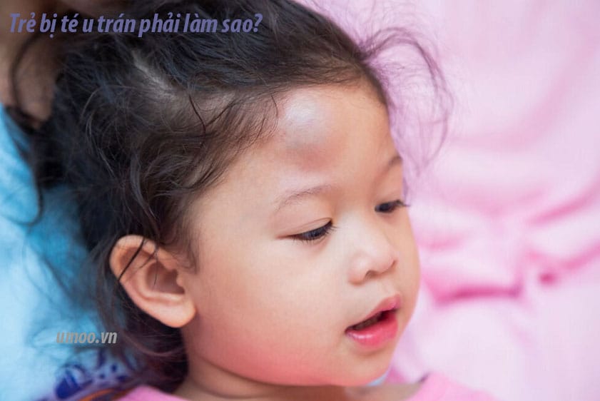 Trẻ bị té u trán phải làm sao, cách xử lí khi bé bị ngã u trán